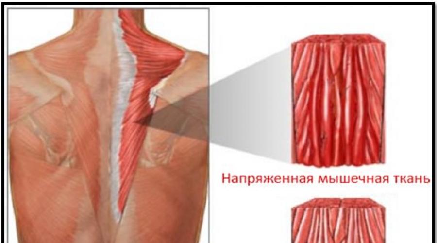 Как бороться с крепатурой мышц. Причины крепатуры мышц